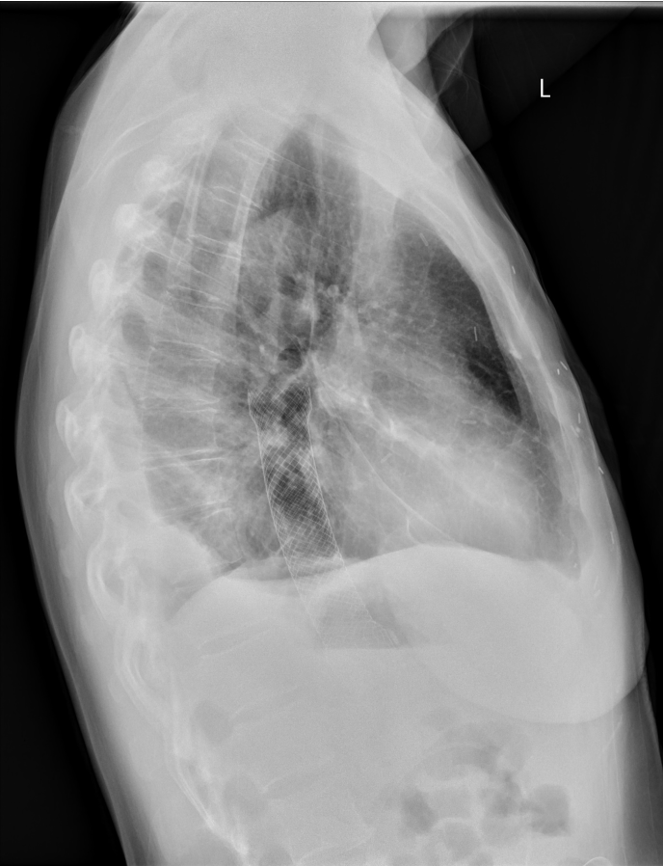 Oesophageal rupture presenting as upper gastrointestinal bleed - The ...