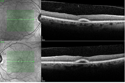 Reversible BRAF inhibitor-induced acute exudative paraneoplastic ...