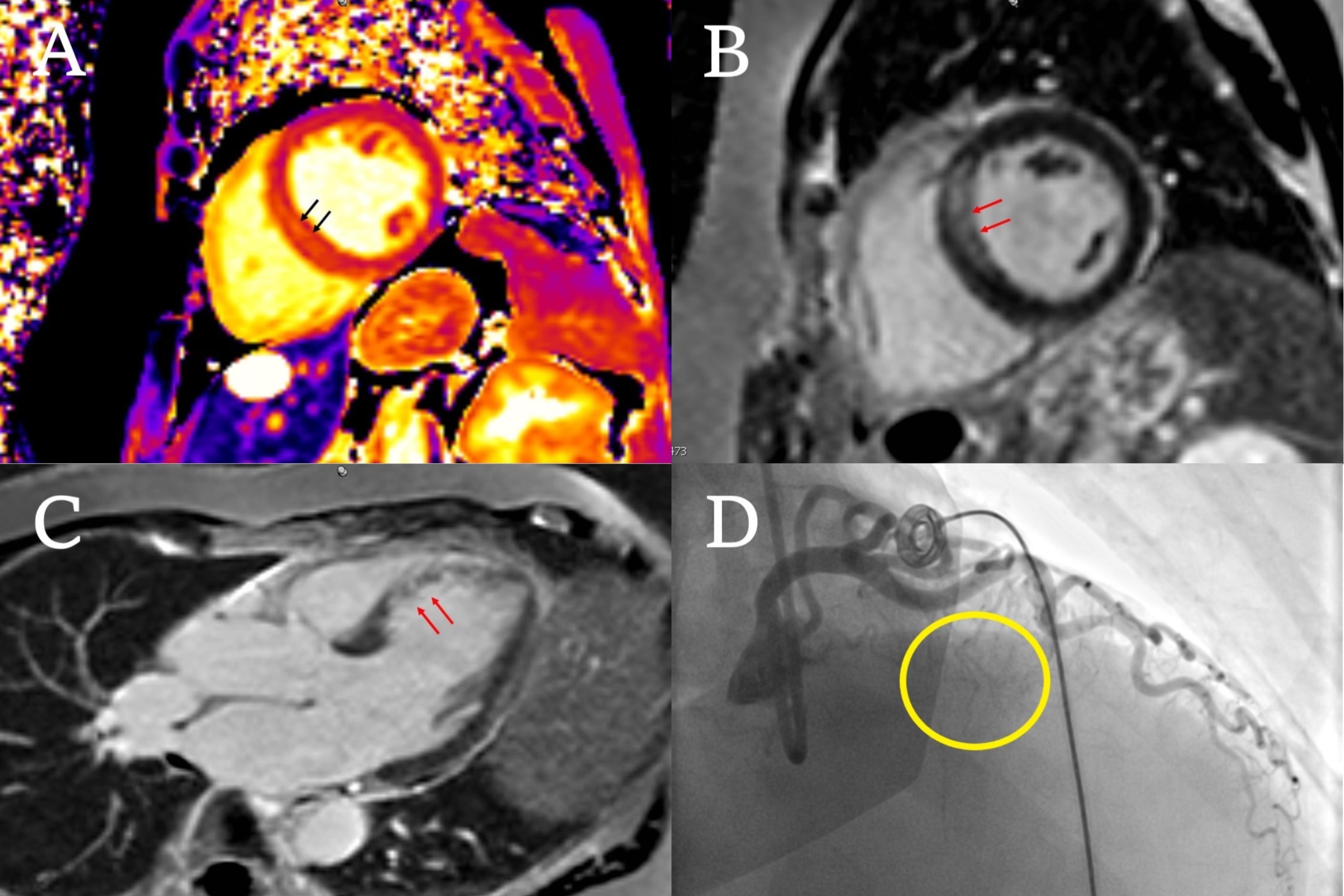 Cardiac magnetic resonance imaging can identify a diagnosis in ...